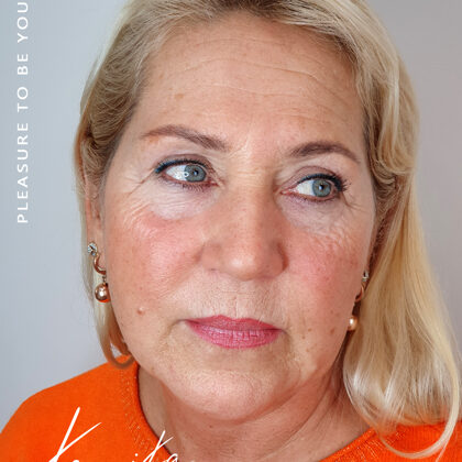 healed result after 1 session of pmu