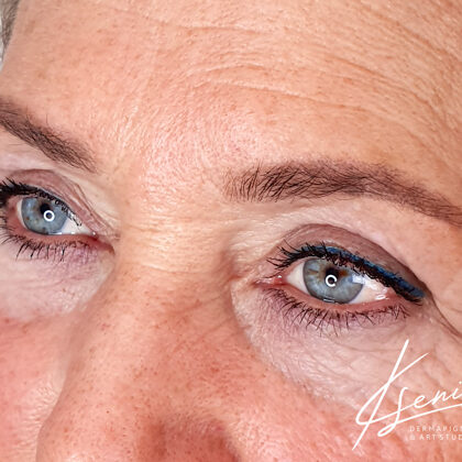 healed result after 1 session of pmu